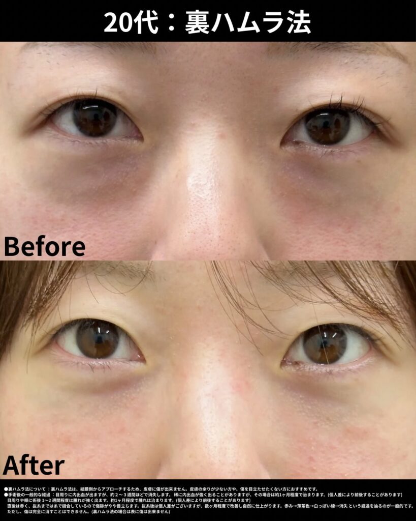 20代裏ハムラ法症例