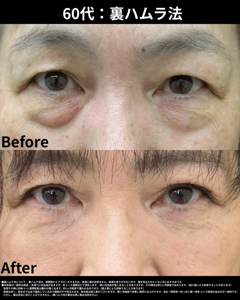 60代裏ハムラ法症例