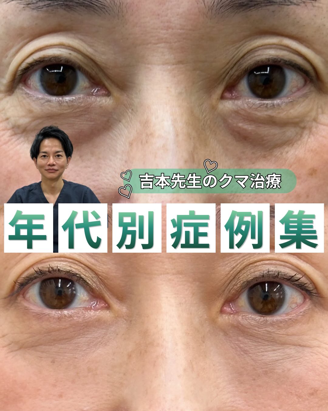 吉本院長のクマ取り治療症例のメイン画像