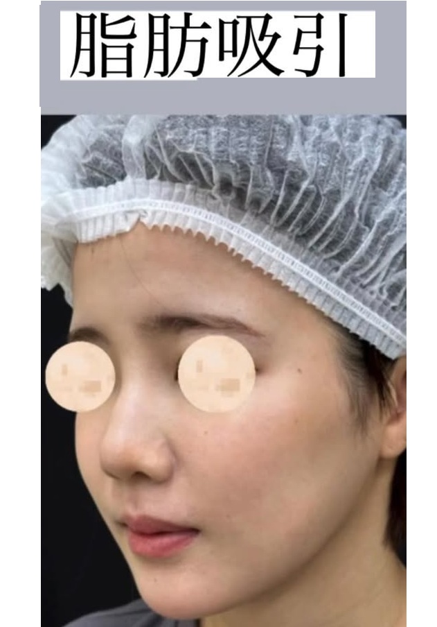 脂肪吸引でお顔の輪郭をシャープにのメイン画像