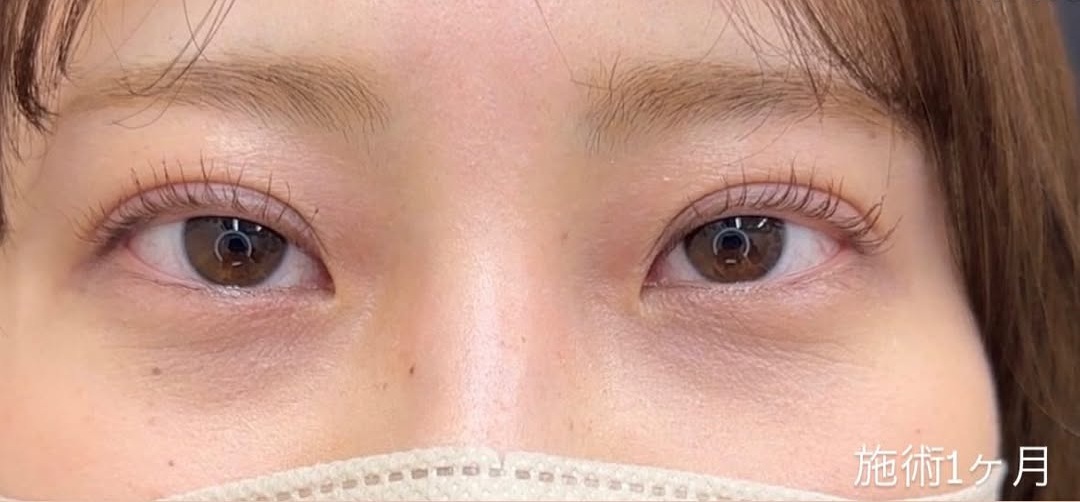 二重整形埋没法症例-シークレットMトリプル-のメイン画像