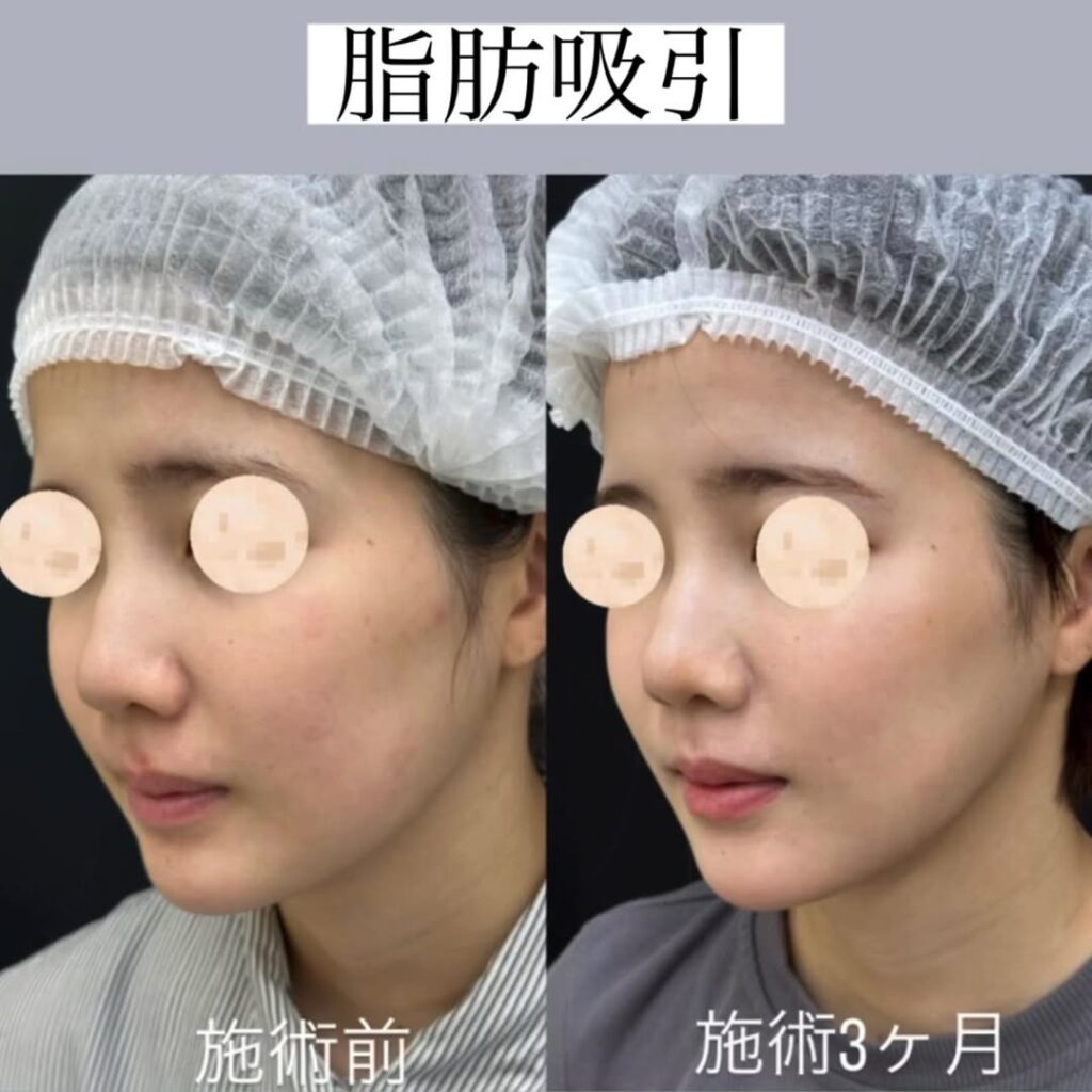 脂肪吸引症例