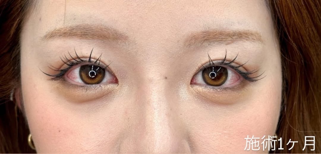 二重整形埋没法の症例 ~持続性が高いシークレットMトリプルのメイン画像
