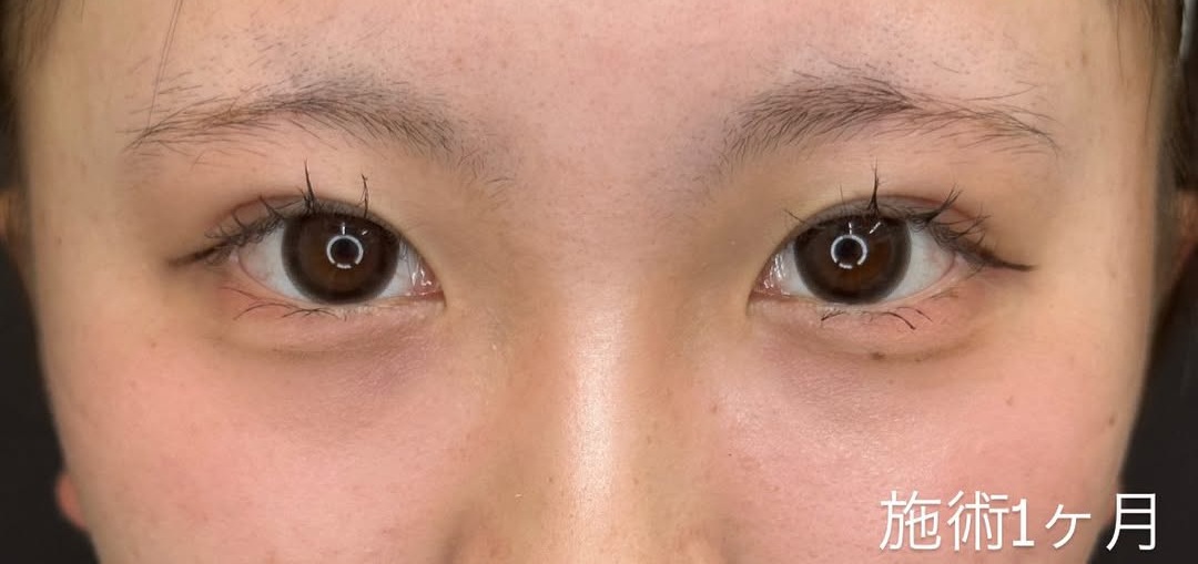 二重整形症例-持続性が高い埋没法-のメイン画像