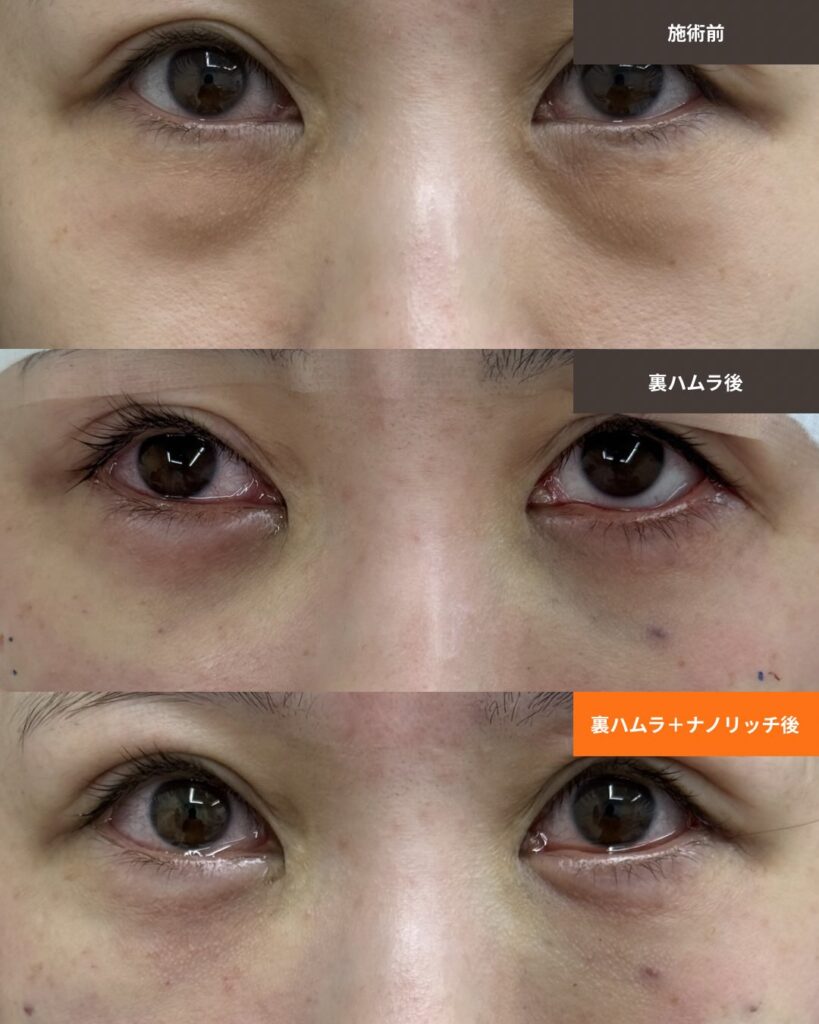 裏ハムラ法