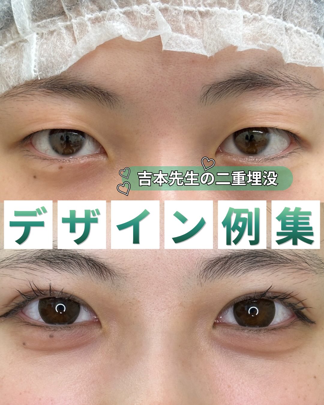 二重整形埋没法デザイン別症例集のメイン画像