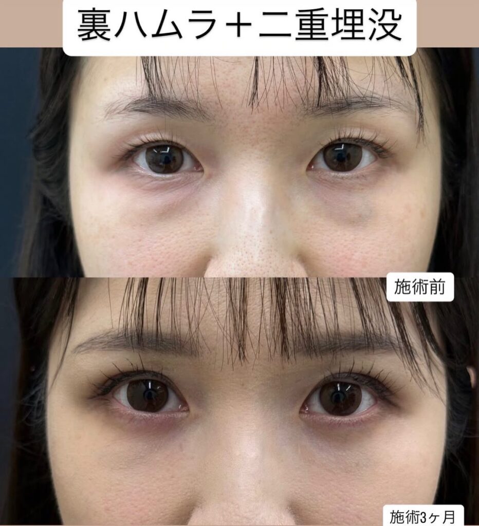 クマ取り＆二重整形