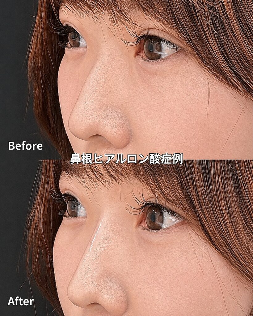 鼻筋ヒアルロン酸