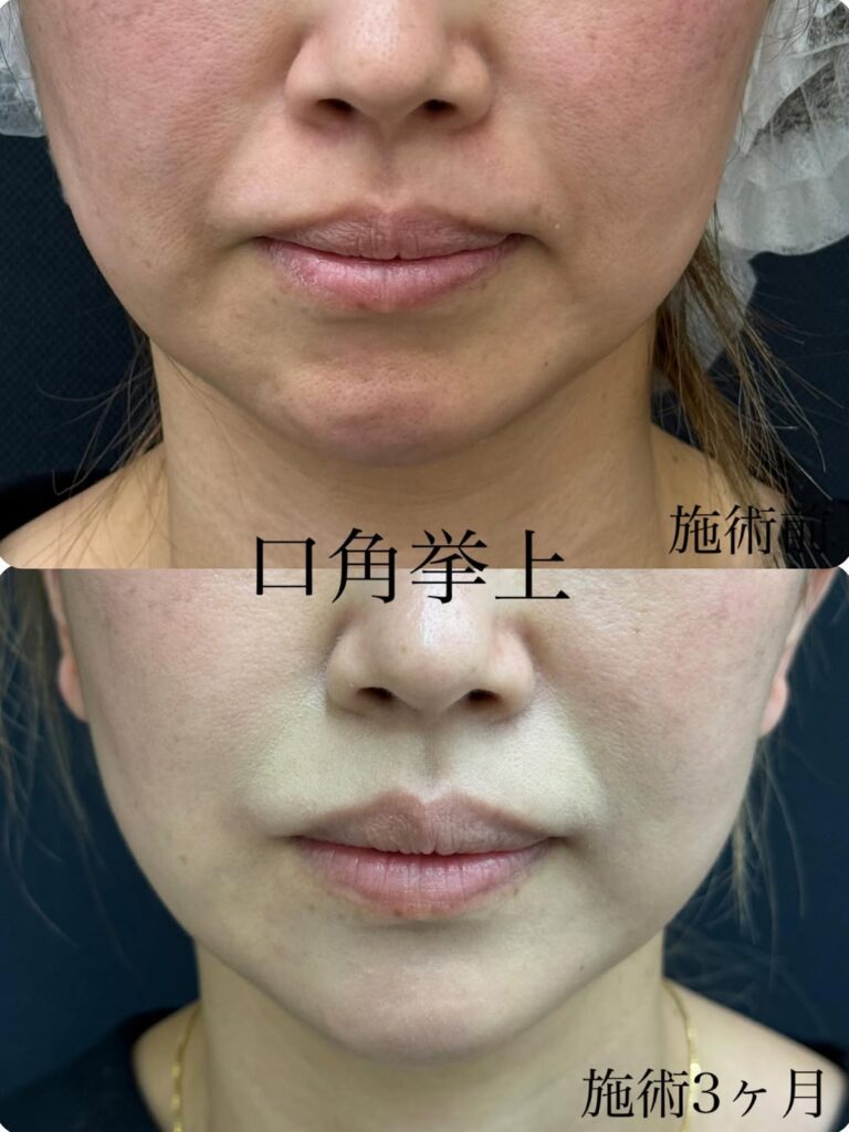 口角拳上