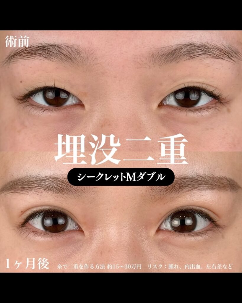 埋没法症例