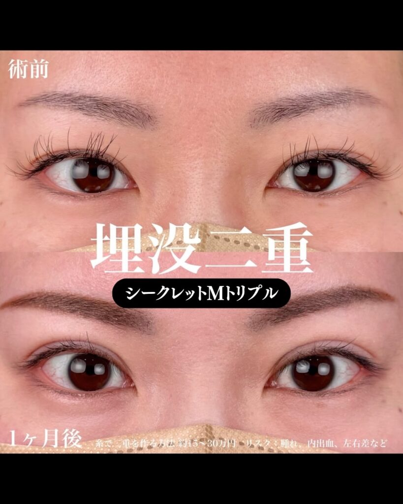 埋没法症例