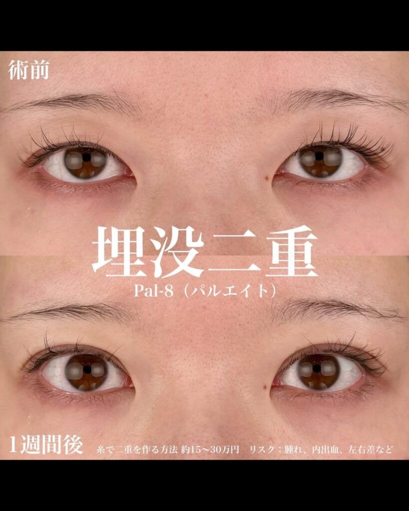 埋没法症例PAl-8