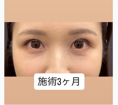 クマ取り＆二重整形複合施術症例のメイン画像