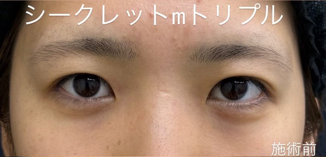 デザイン性＆持続性が最高ランクの二重埋没法のメイン画像