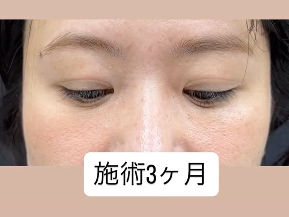 自然に若返る裏ハムラ法（クマ取り治療）のメイン画像