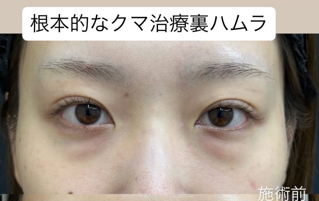 根本的なクマ取り治療のメイン画像