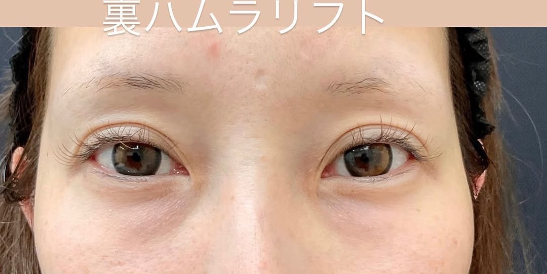 クマ取り症例 裏ハムラ＋ミッドフェイスリフトのメイン画像