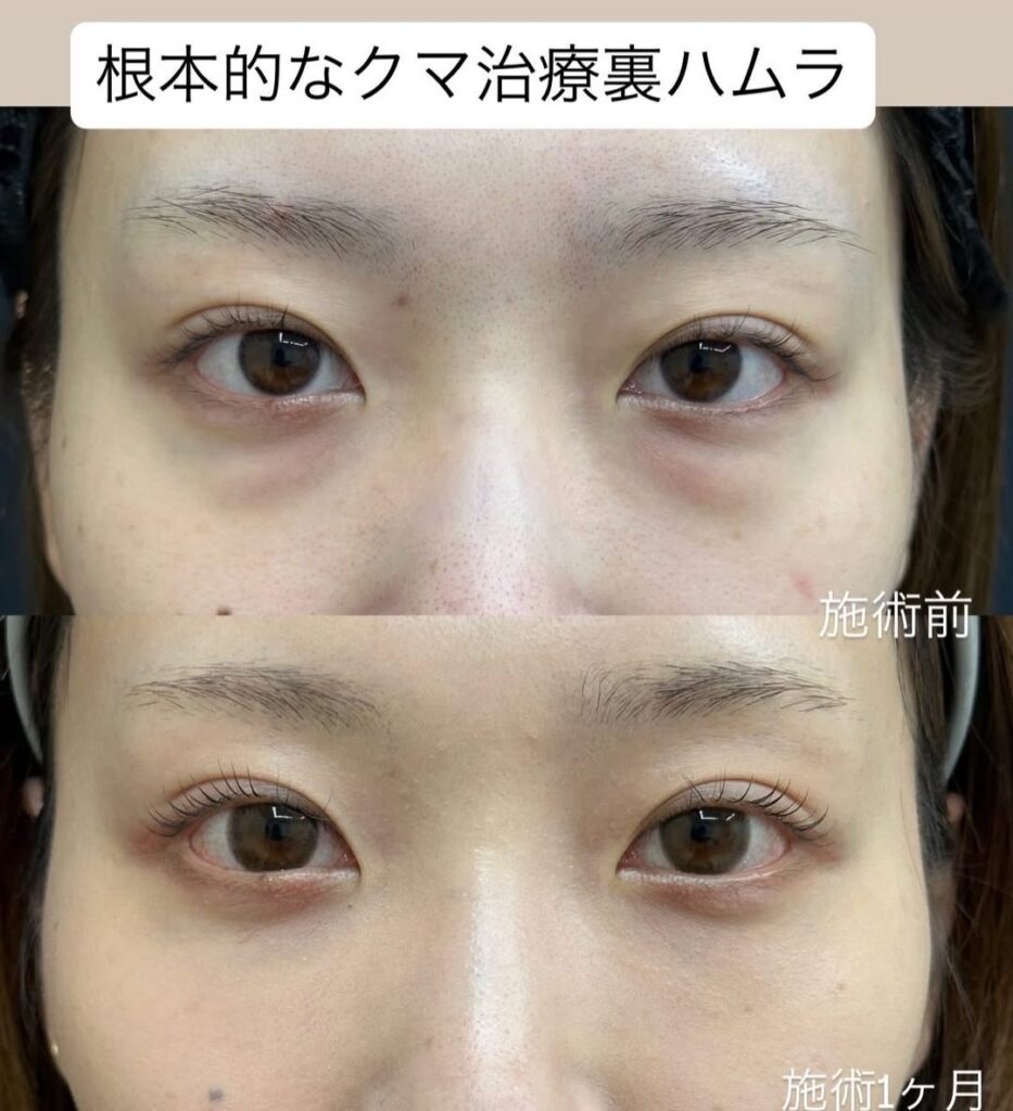裏ハムラ法症例