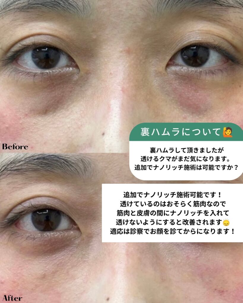追加ナノリッチ