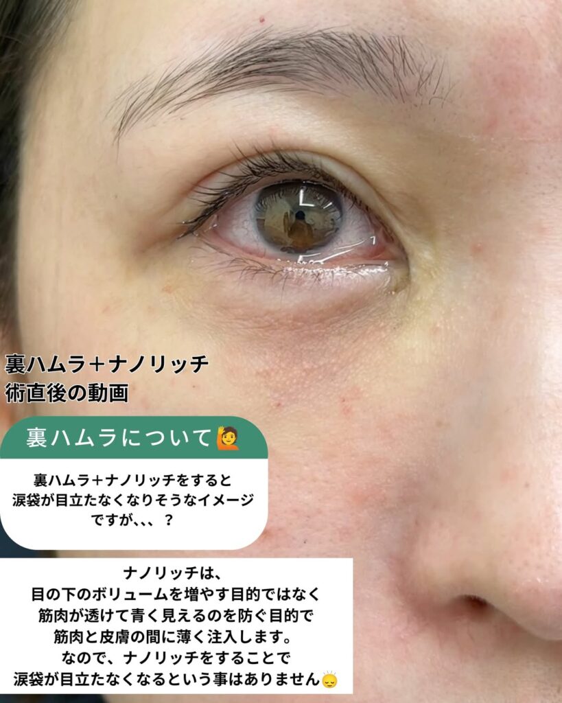 裏ハムラナノリッチ