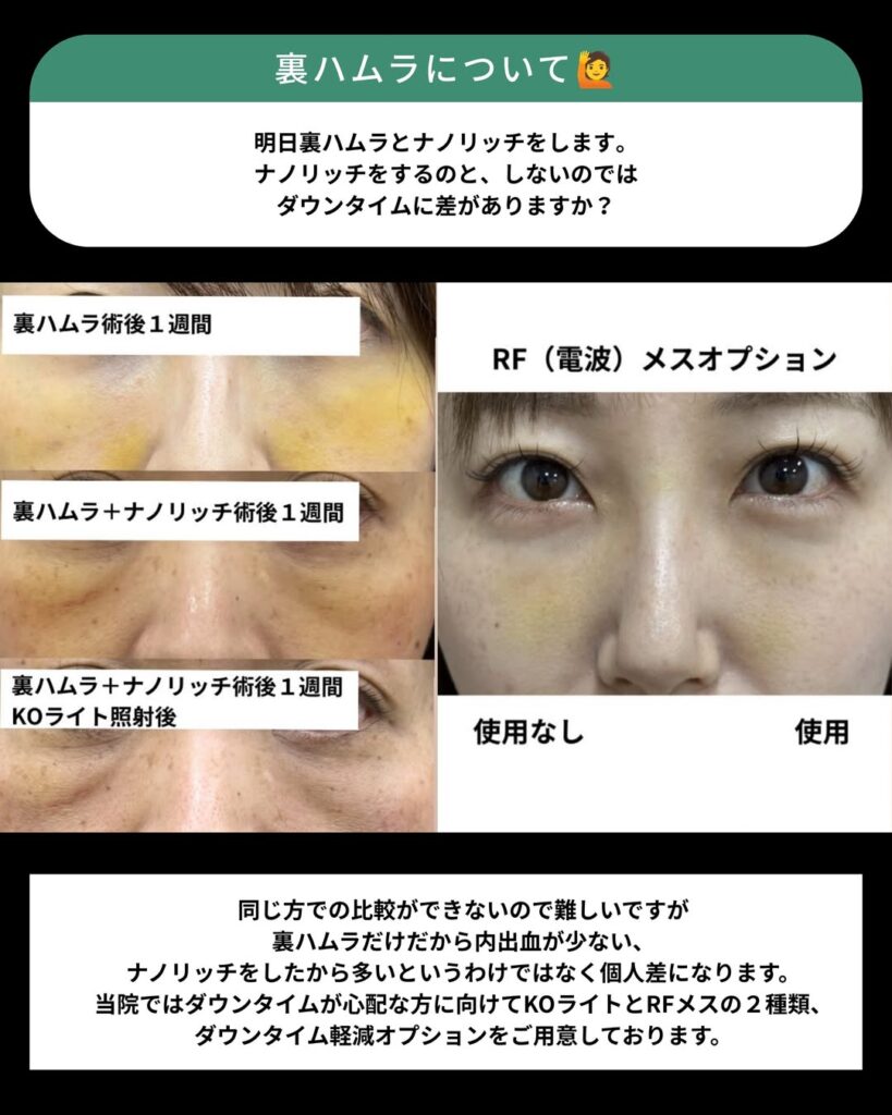ダウンタイム