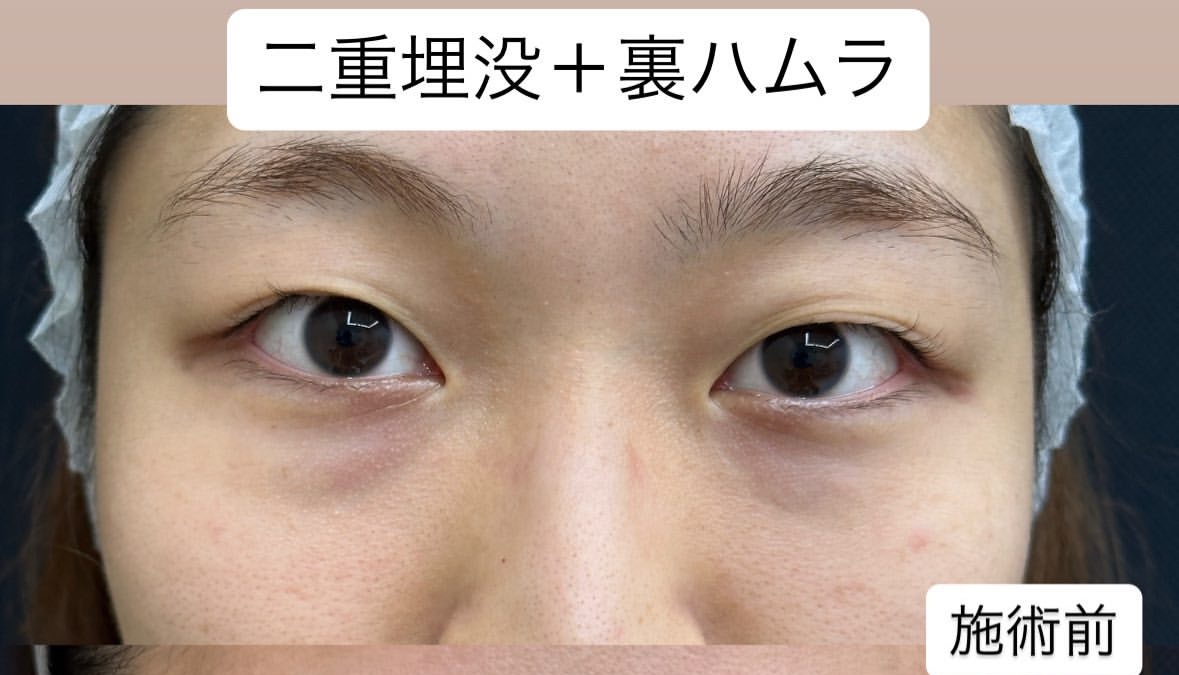 目周り人気の複合治療の症例のメイン画像