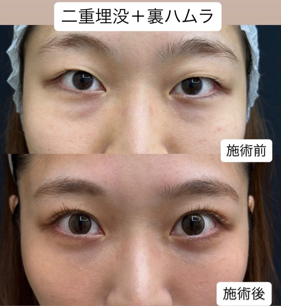 二重＆クマ取り