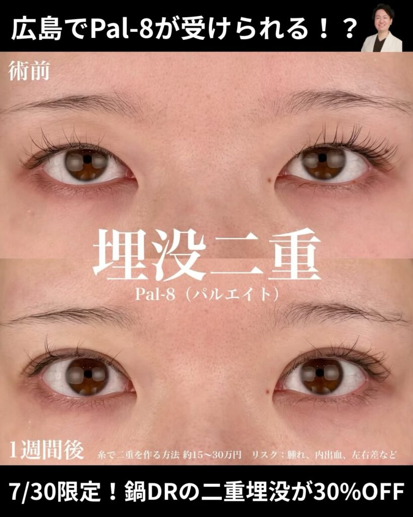 埋没二重