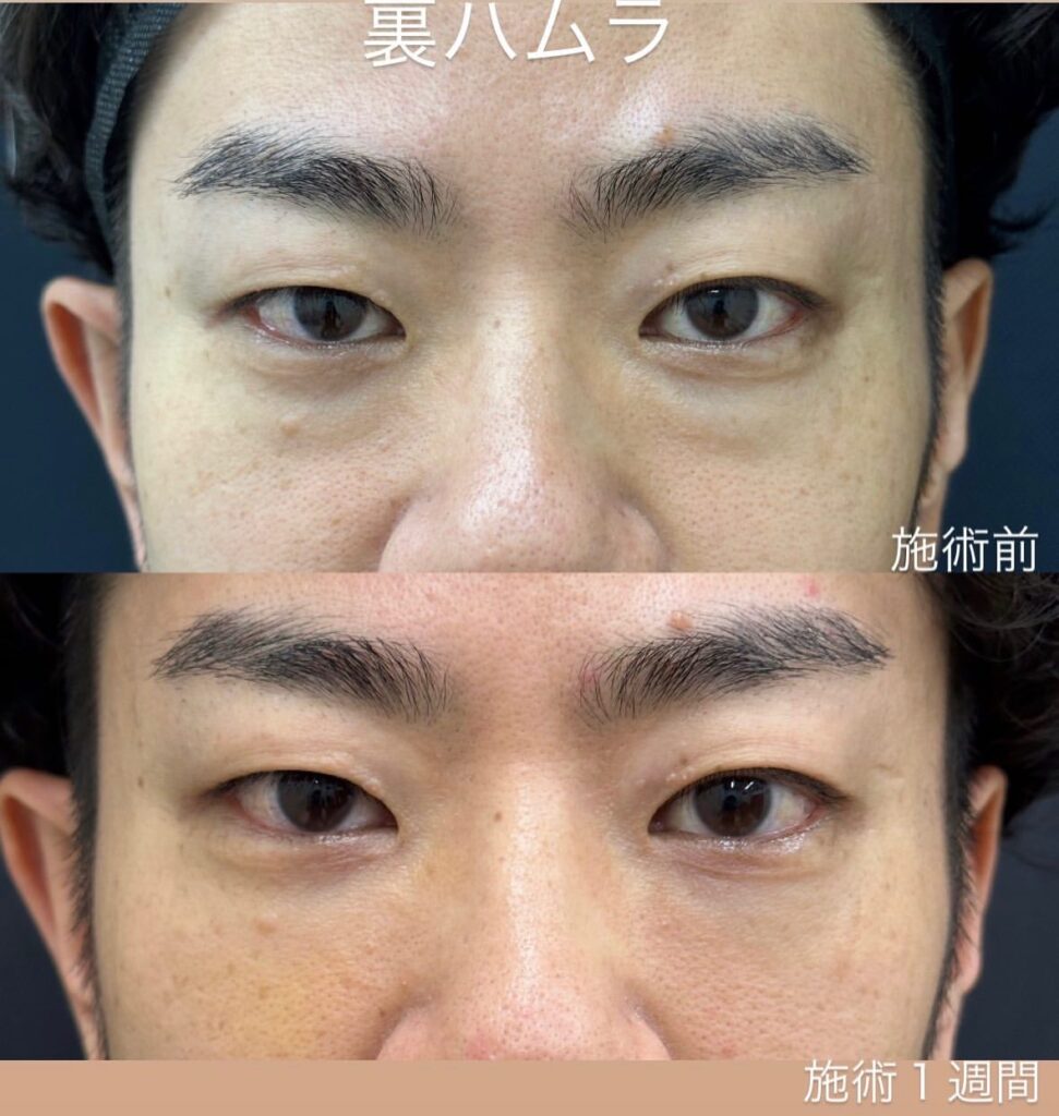 裏ハムラ法