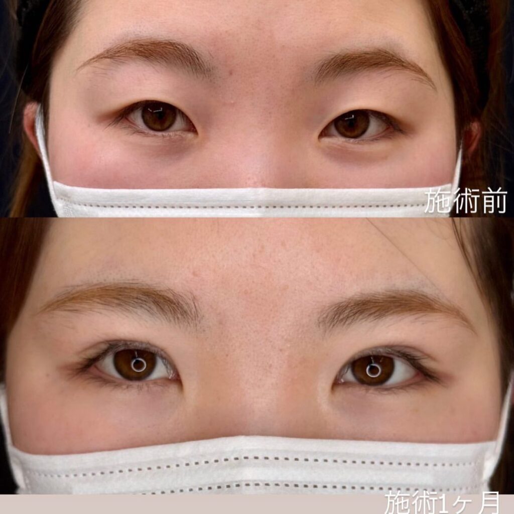 埋没法